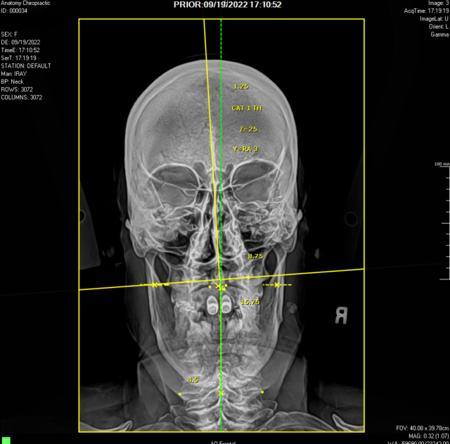 Still can’t sleep? How getting a C1 adjustment can help you sleep ...